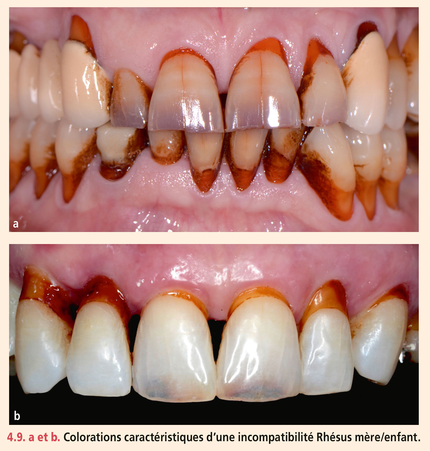 Dyschromies dentaires