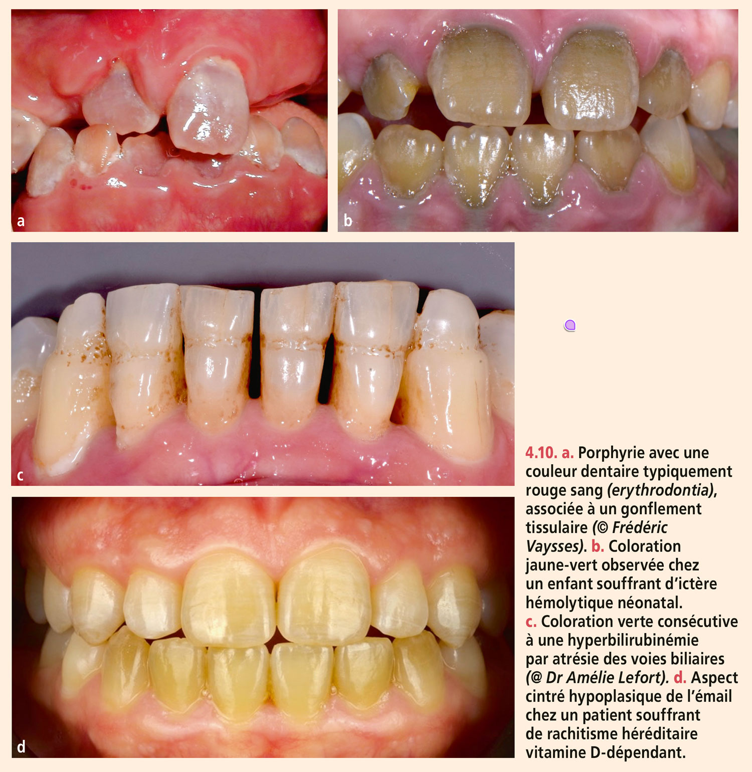 Dyschromies dentaires