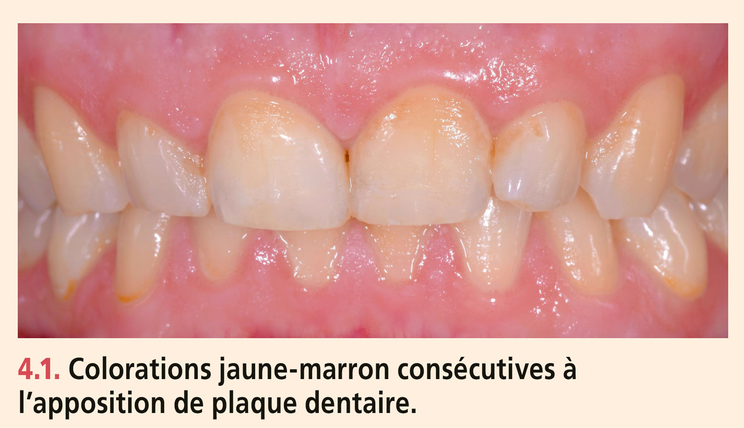 Dyschromies dentaires
