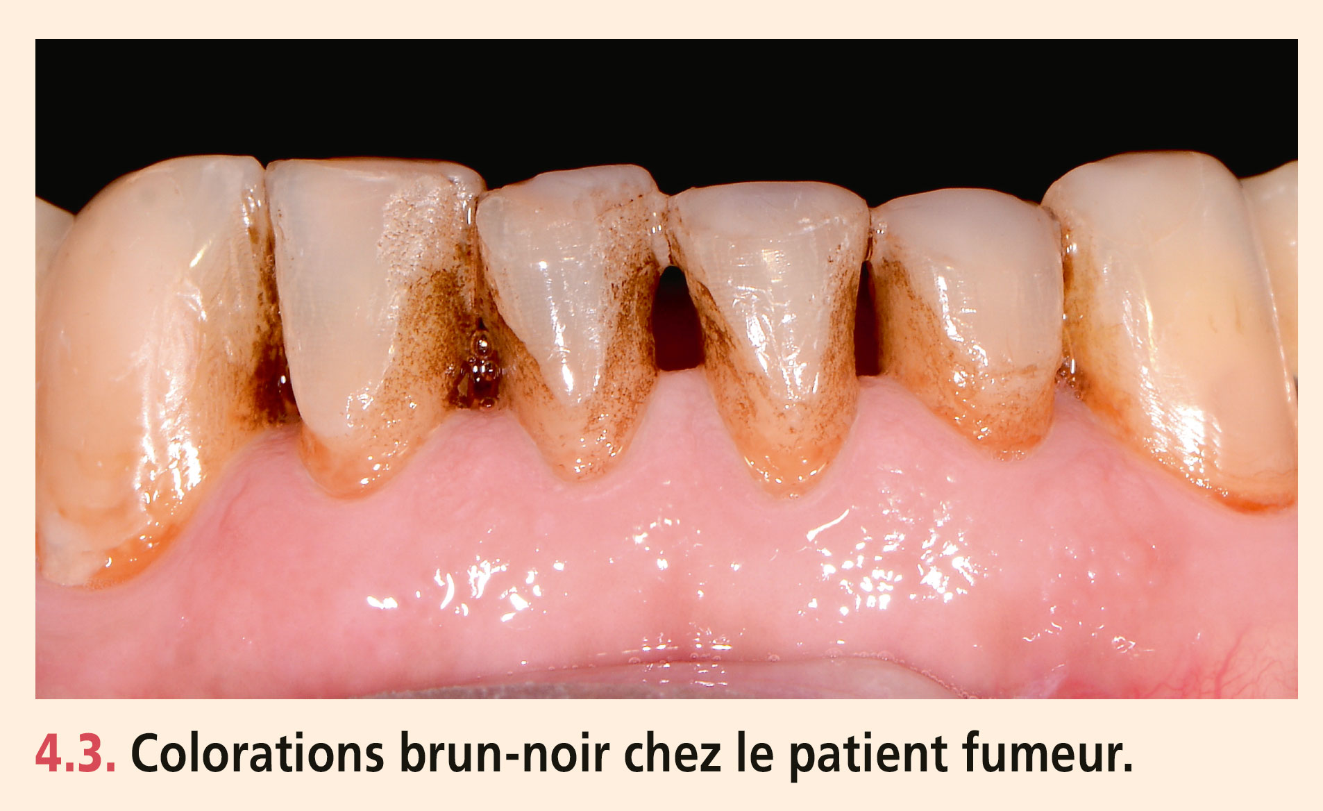 Dyschromies dentaires