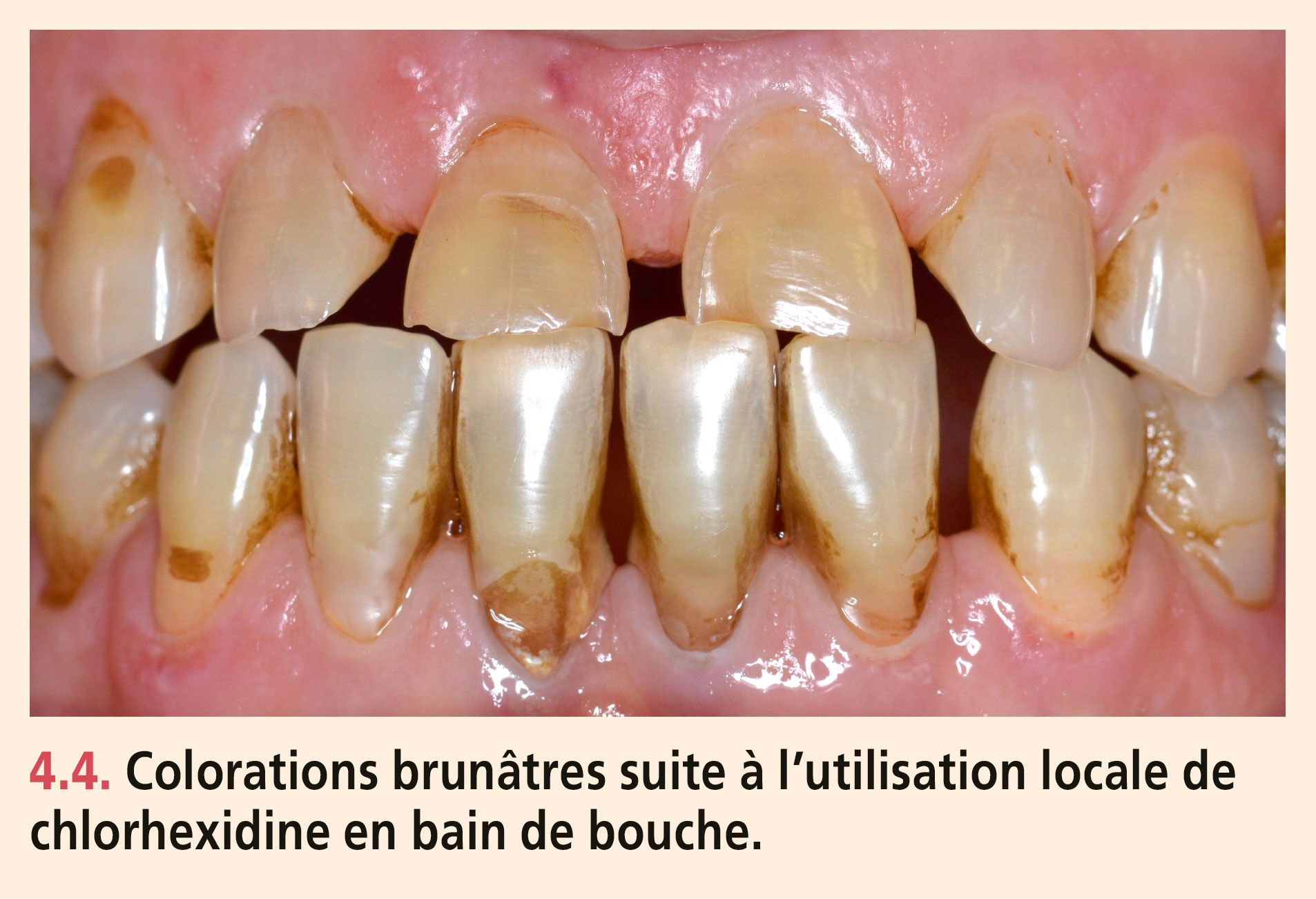 Dyschromies dentaires