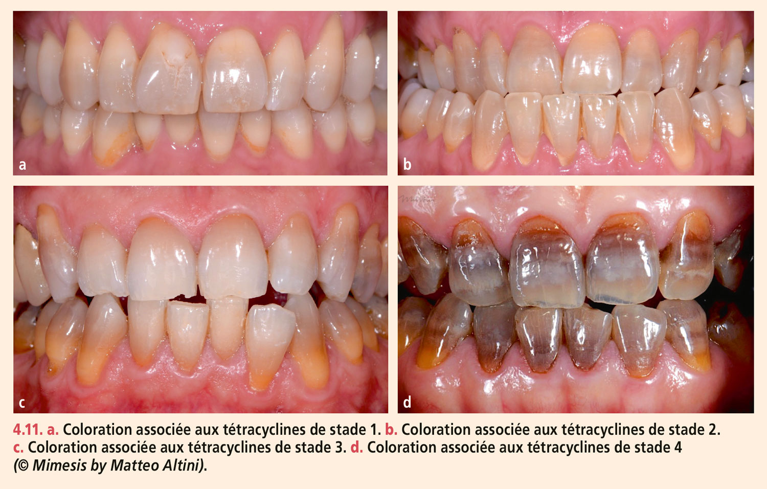 Dyschromies dentaires