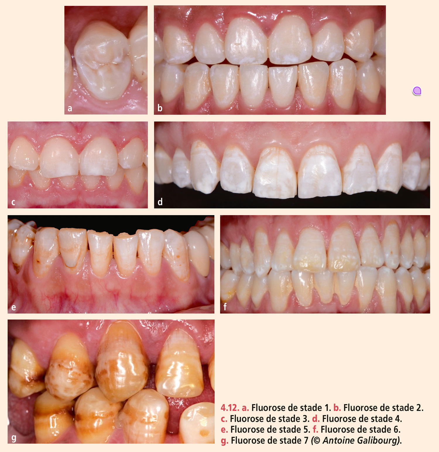Dyschromies dentaires
