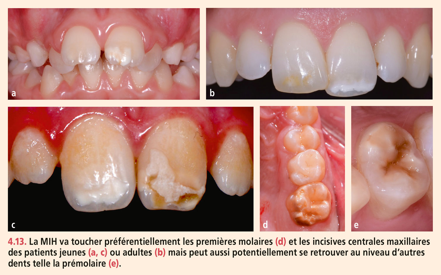 Dyschromies dentaires