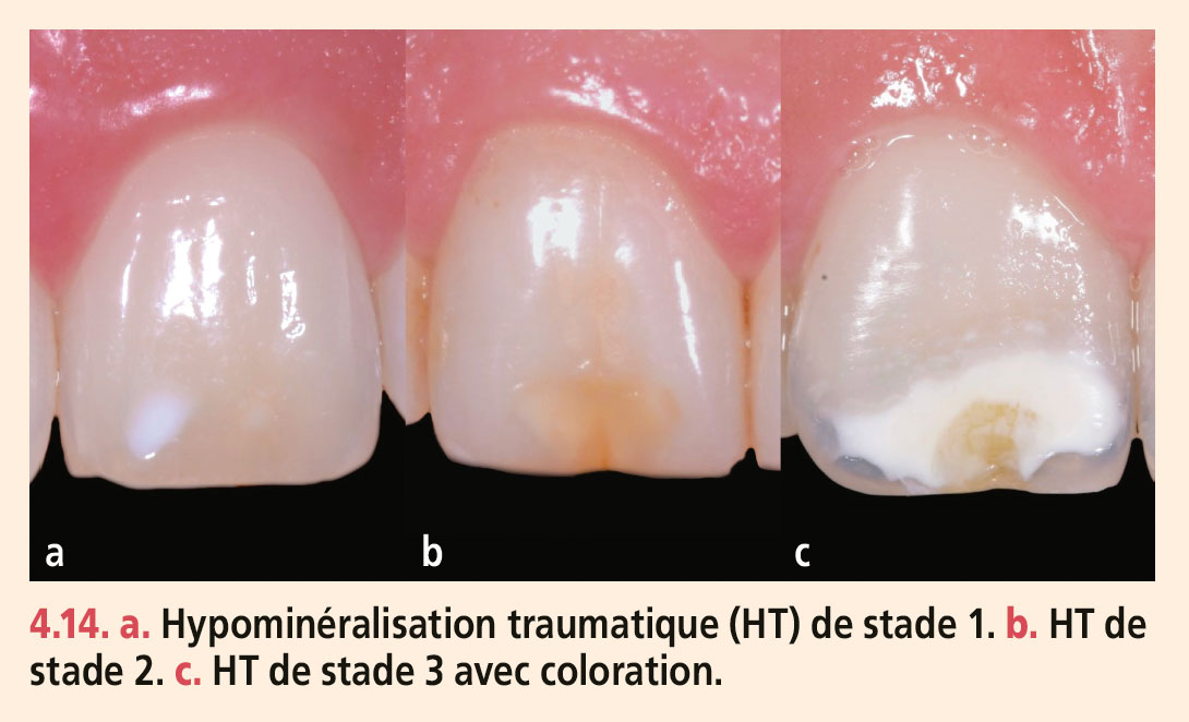 Dyschromies dentaires