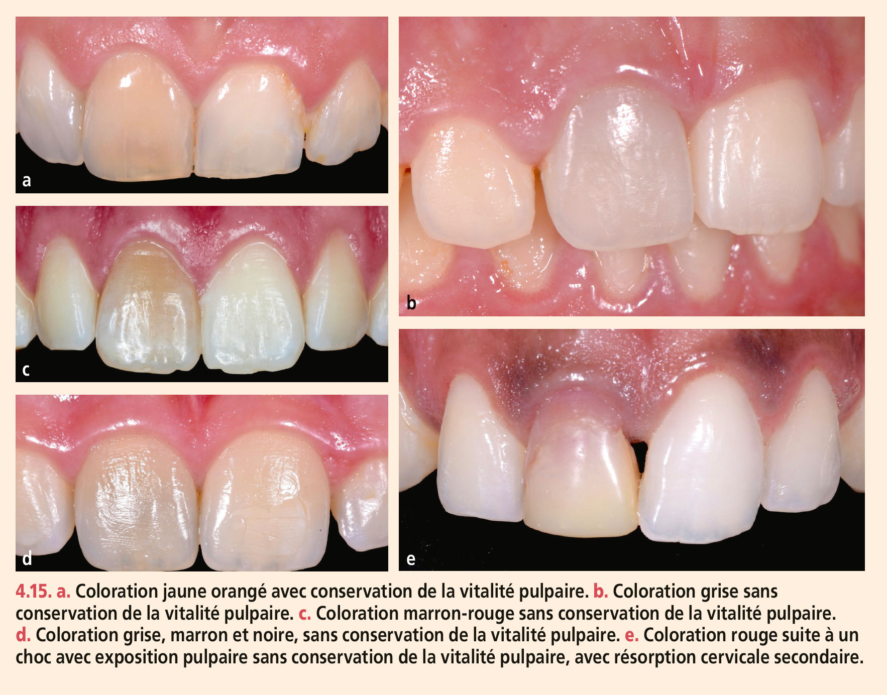 Dyschromies dentaires