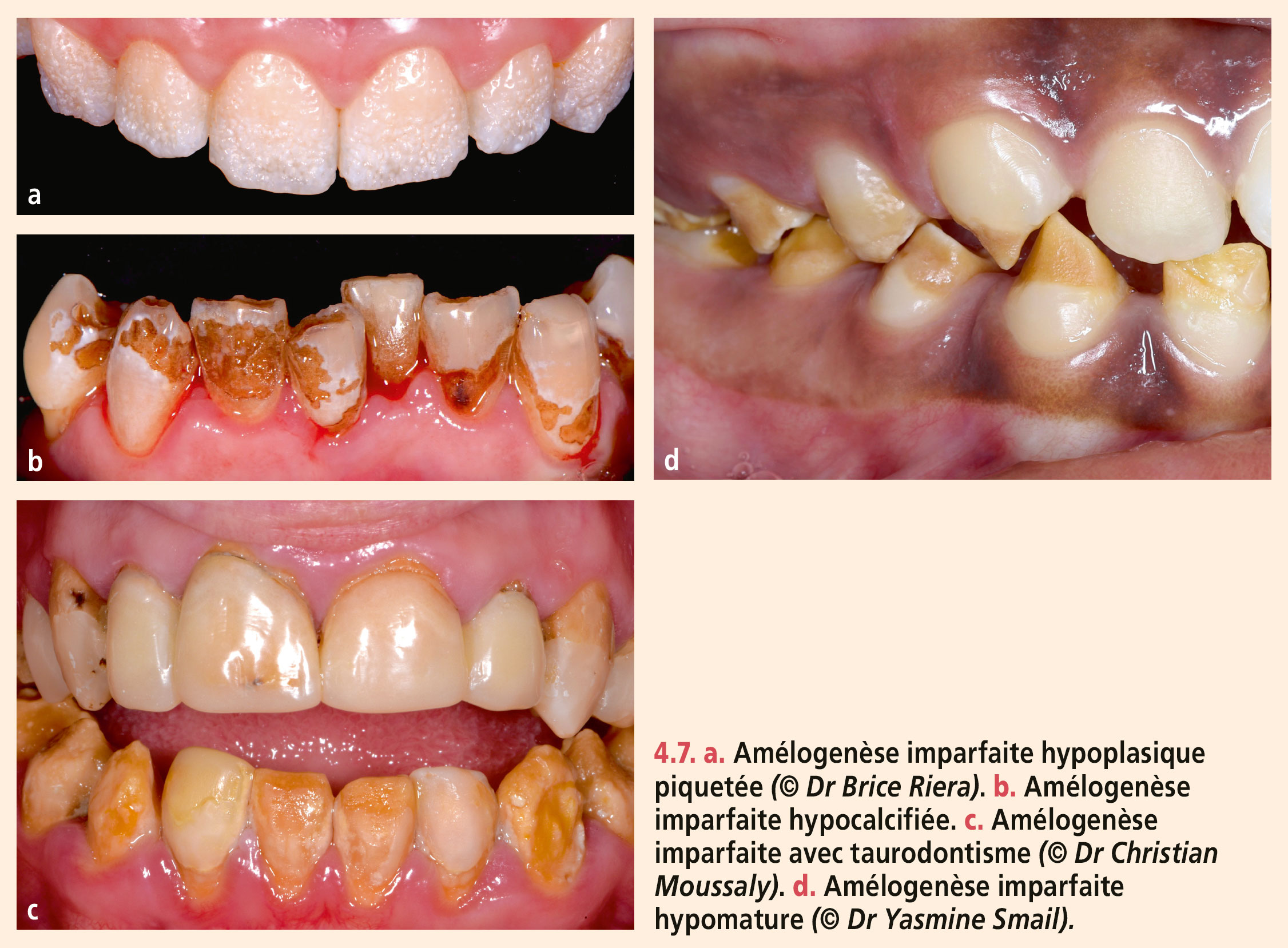 Dyschromies dentaires