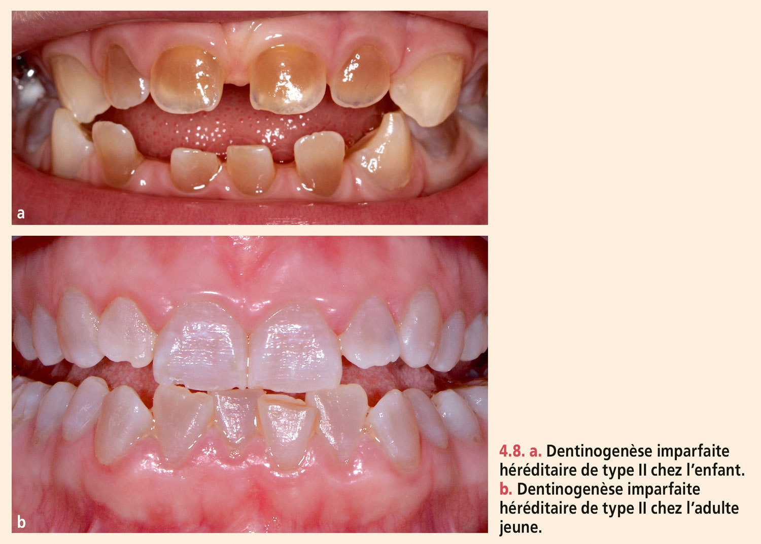 Dyschromies dentaires
