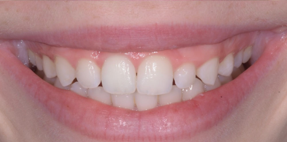 eclaircissement-dentaire-05B