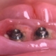 implants dentaires