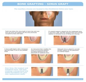 sinus-graft